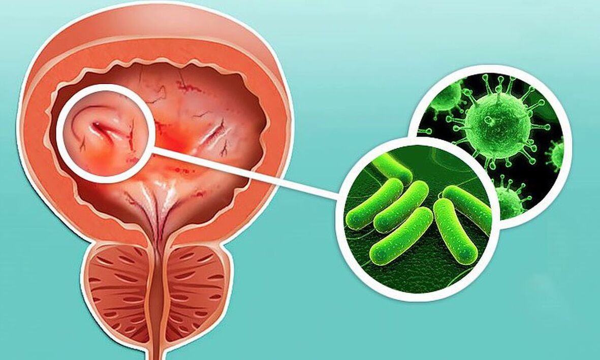 How cystitis occurs