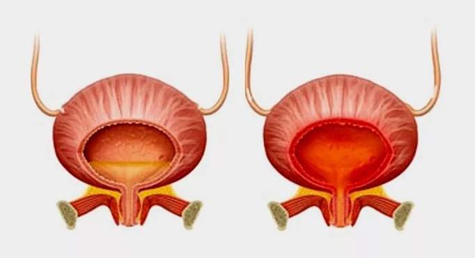 Normal bladder (left) and cystitis with inflammation (right)